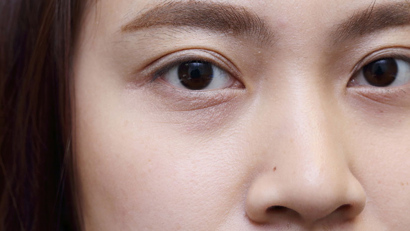An-Easy-Way-to-Get-Rid-of-Eye-Bags