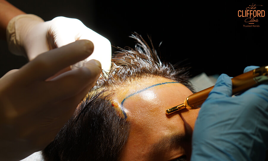 Regenera Activa VS FUE Hair Transplant: What's The Difference?