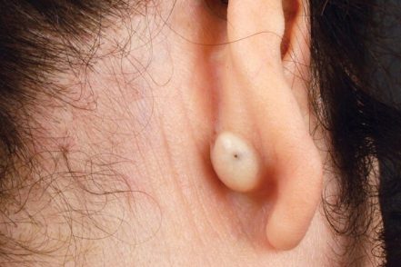 Lumps, Nodules and Cysts Around the Ears - The Clifford Clinic