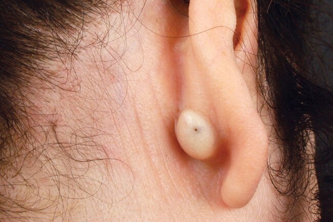 sebaceous cyst beside the ear