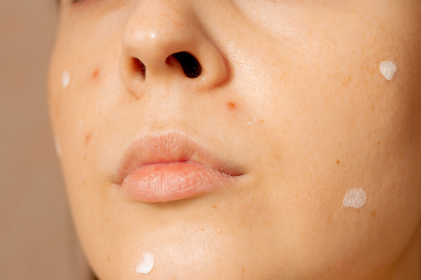 Get Rid Of Acne Scars, Acne Scar Removal