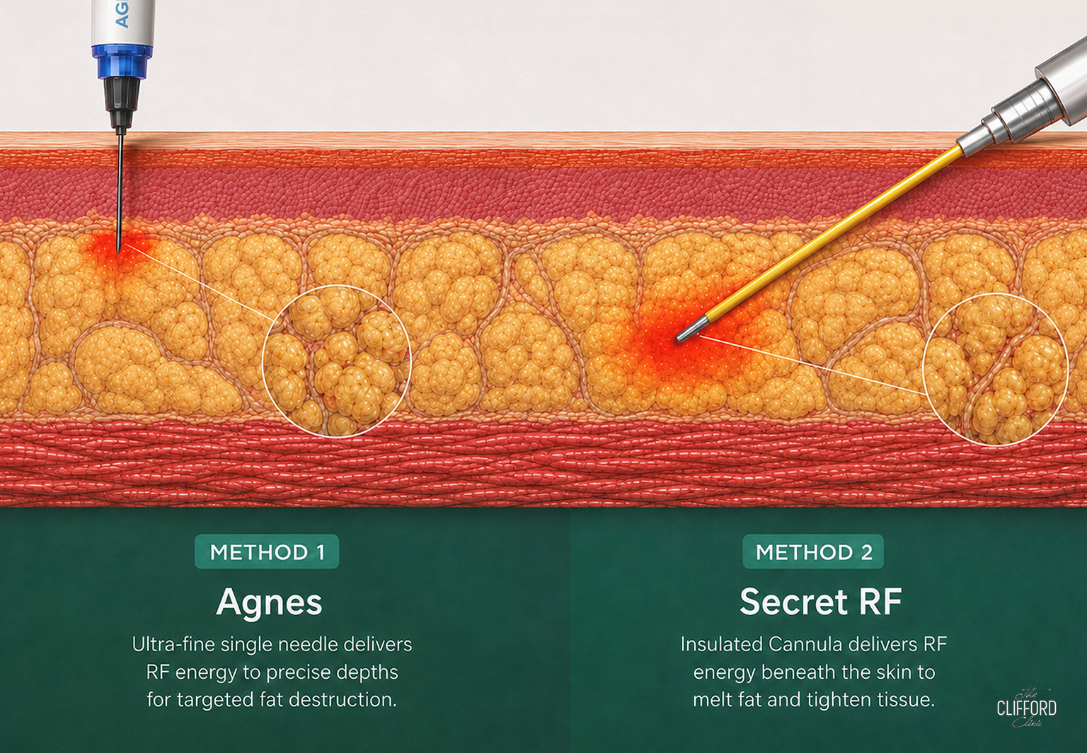 Eyebag Treatment Singapore