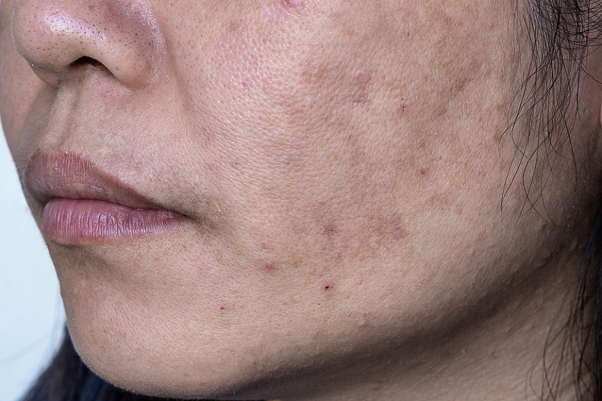 for meget Føderale Kejserlig Blackheads vs Whiteheads vs Pimples: Best Treatment Options