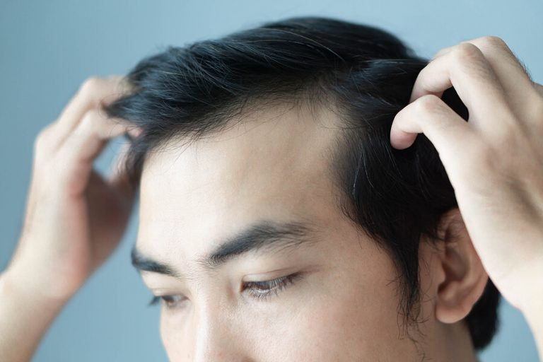 Can a hair transplant fix my receding hairline? Find out here