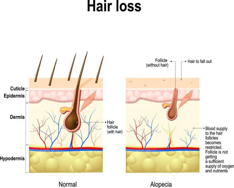 Does Hair Transplant Procedure Hurt?
