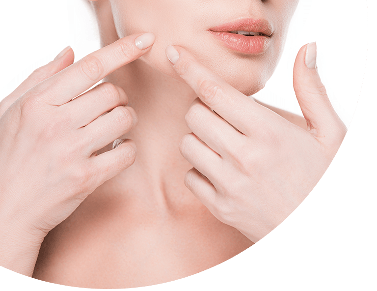 cystic acne singapore