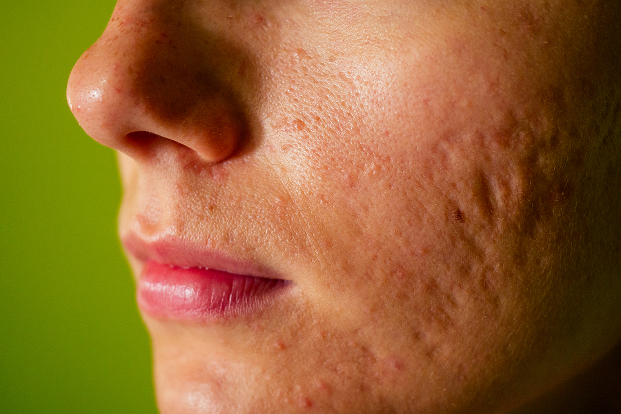 Hypertrophic acne scars treatment