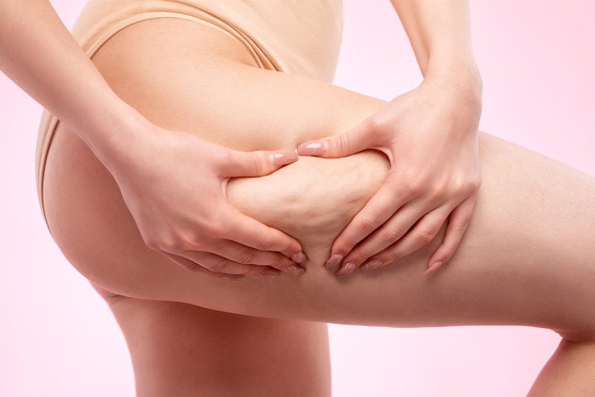 Everything You Need To Know About Cellulite Removal