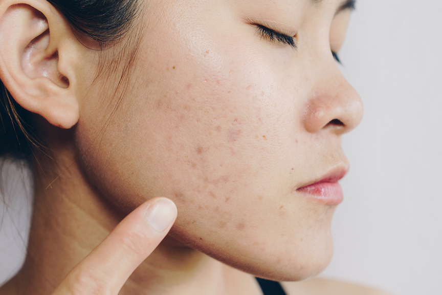 When To Seek Professional Help For Acne: 3 Tell-Tale Signs