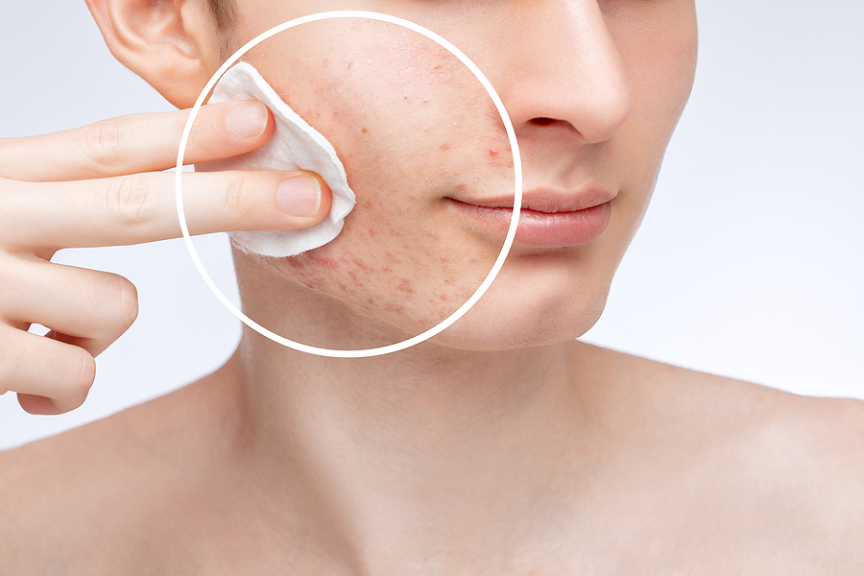 Achieve A Flawless Complexion: How To Reduce Acne Scars