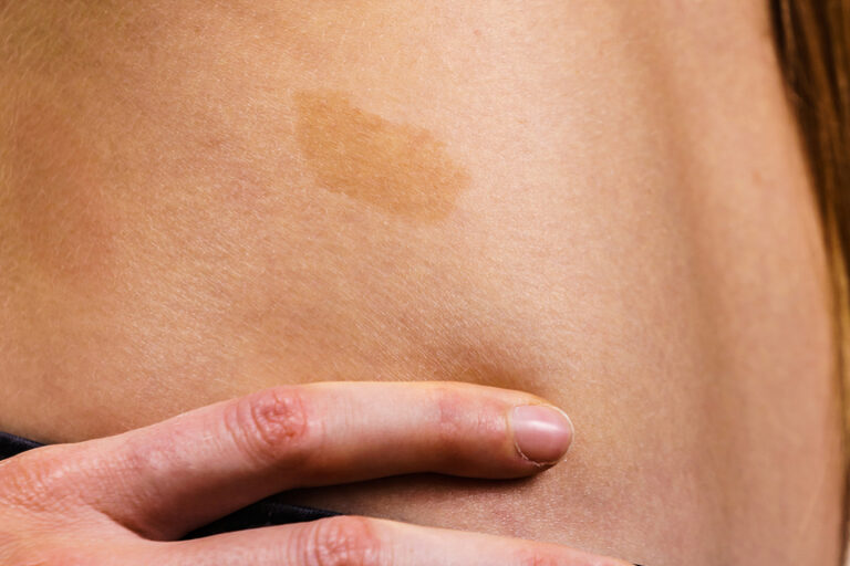 Letter Birthmark Cafe Au Lait Birthmarks: What They Are & Treatment Options