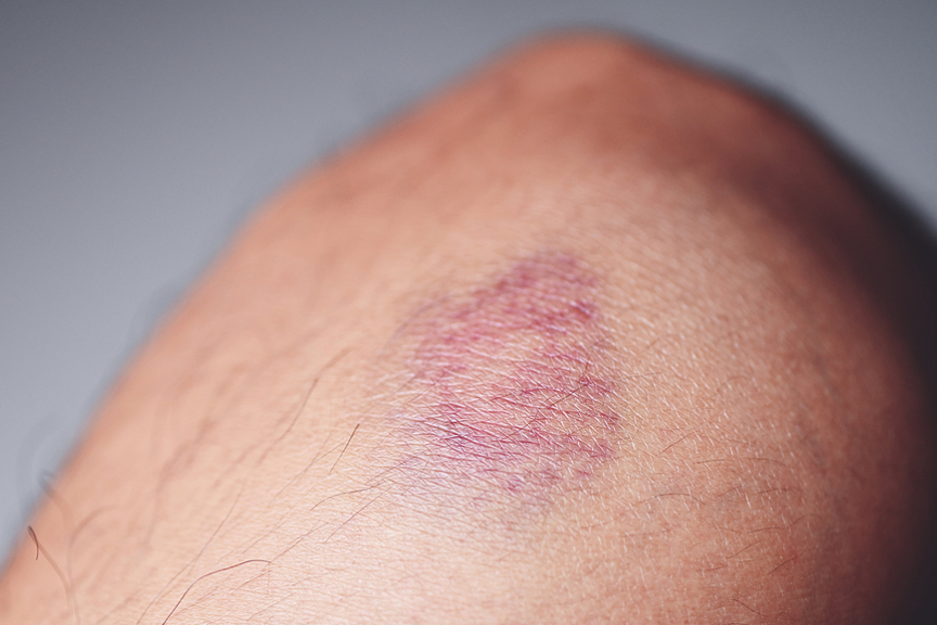 How V-Beam Can Help Treat Bruises & Other Treatment Options