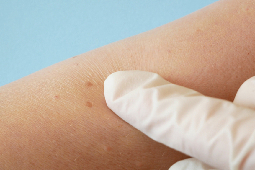 Vascular VS Pigmented Birthmarks: What Are Their Differences?