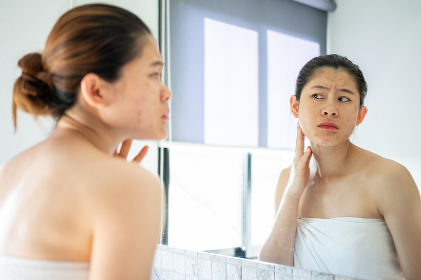 The Problem With At-Home Acne Scar Removal Remedies