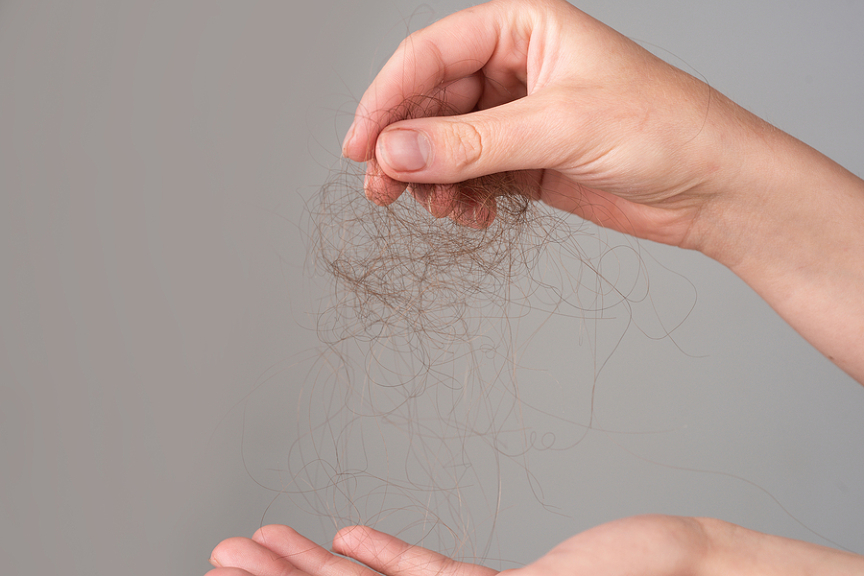 All You Need To Know About Female Pattern Hair Loss