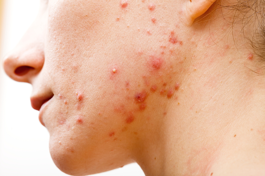 5 Causes Of Cystic Acne And The Treatment Options Available