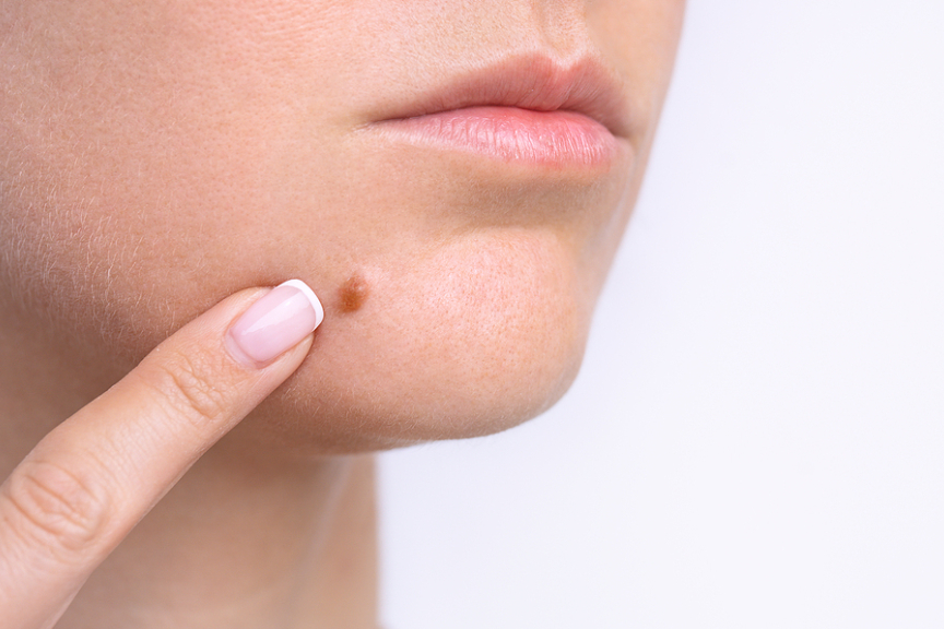 The Hidden Dangers: Why Picking At Moles Can Be Risky Business