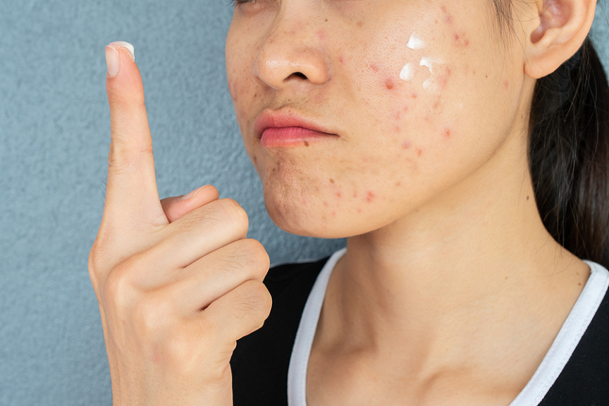 Over-The-Counter Acne Scar Creams: Are They A Bad Investment?