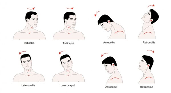 Botox Injections Utilise Botulinum Toxin To Cause Controlled Mbotox 