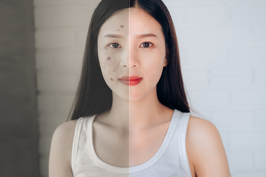 Whitening And Acne Removal Effects of Centella Asiatica Gotu Kola Extract Whitening And Acne Removal Effects of Centella Asiatica Gotu Kola Extract