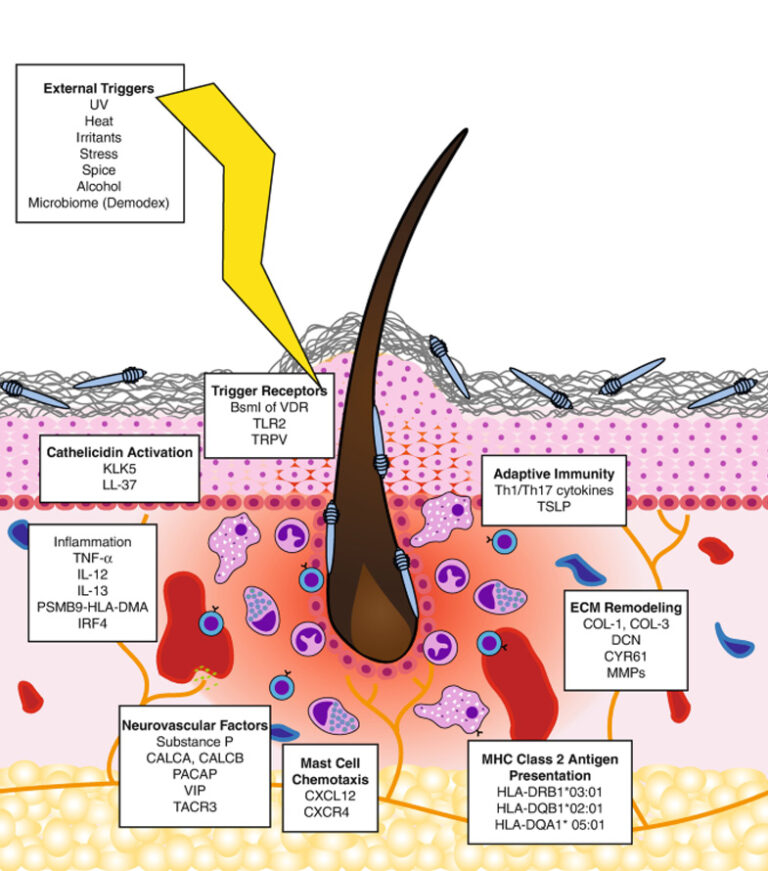 Purulent Pyoderma Pyoderma Faciale (Rosacea Fulminans)