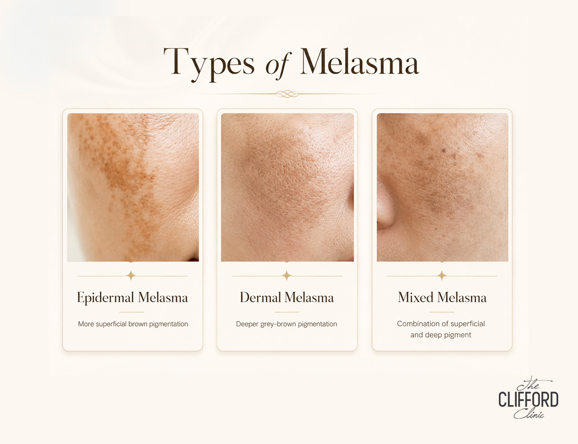 Why Melasma Needs Low-Heat, Long-Game Treatment: How Lorient Element Skin Booster can help - The Clifford Clinic Why Melasma Needs Low-Heat, Long-Game Treatment: How Lorient Element Skin Booster can help - The Clifford Clinic