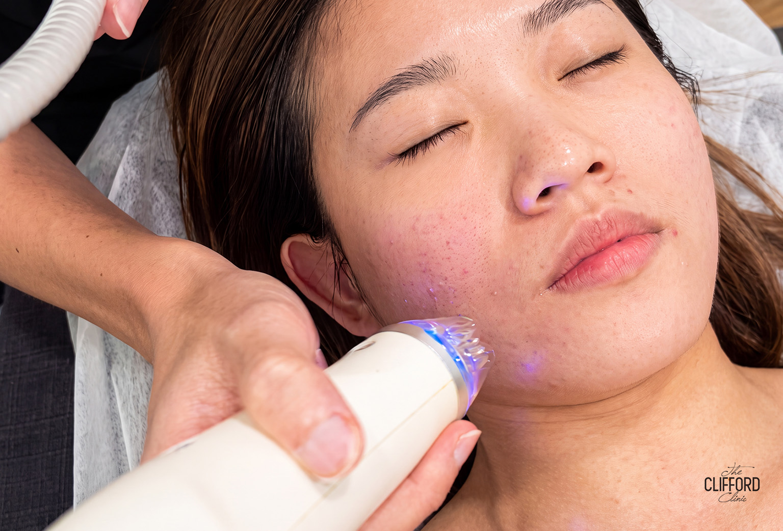 Acne Scar Treatment