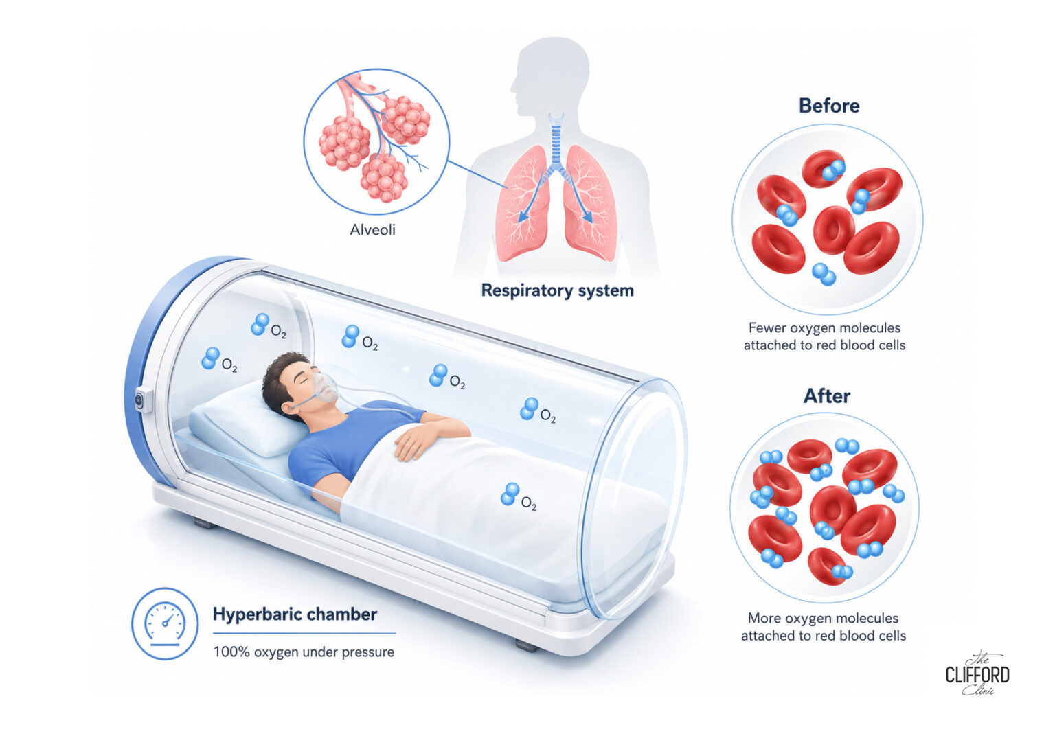 Side Effects and Safety Of Hyperbaric Oxygen Therapy: An Evidence-Based ...