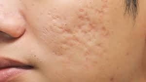 Boxcar acne scars
