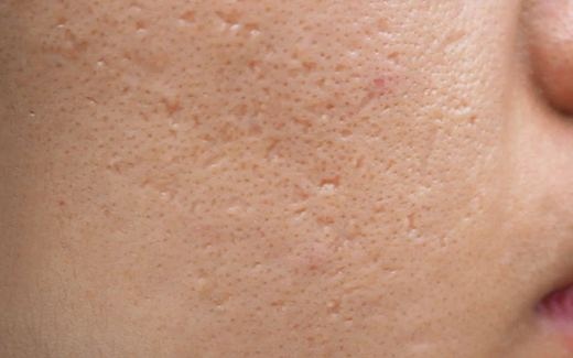 Ice-pick acne scars
