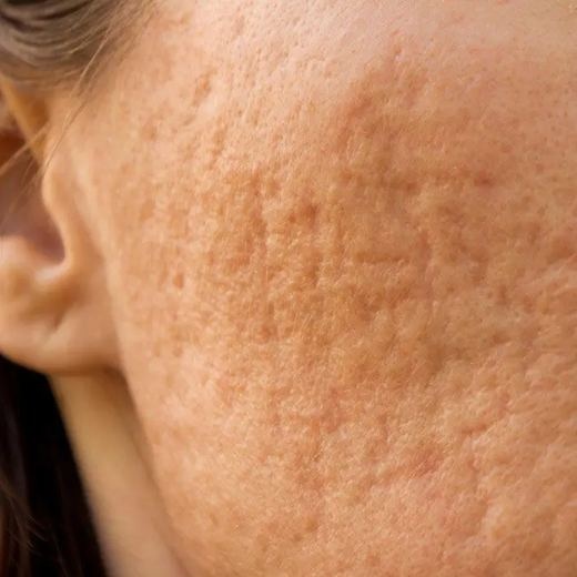 Rolling acne scars
