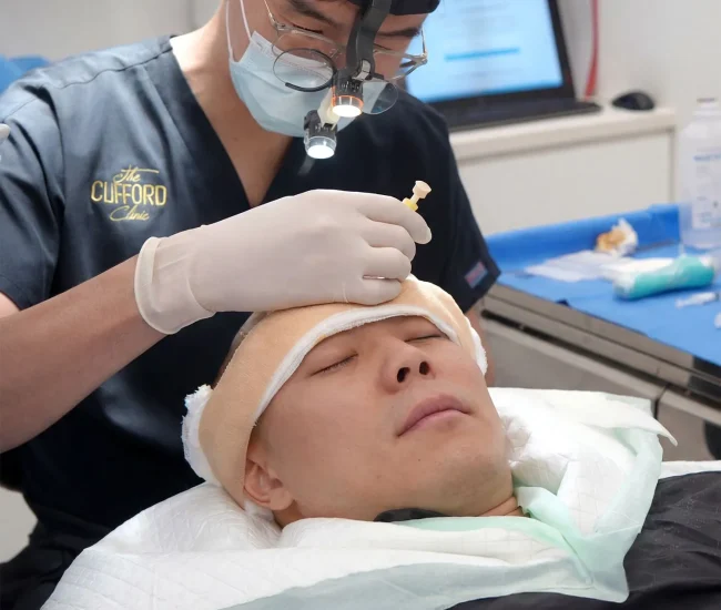 Hair Transplant Singapore