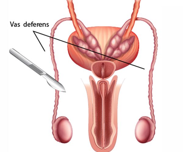 Vasectomy Singapore. Diagram