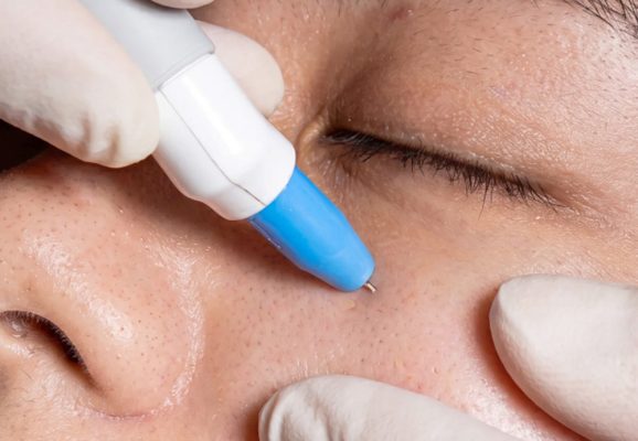 eyebag treatment agnes