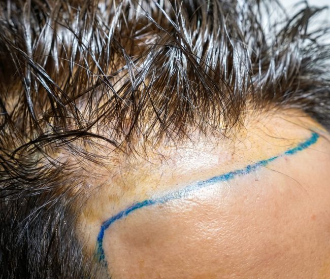 hair transplant singapore