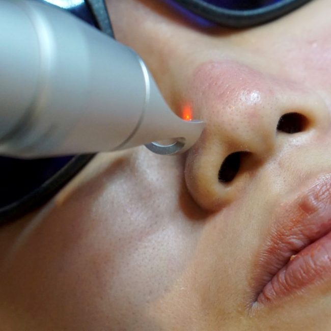 pico laser _ close up